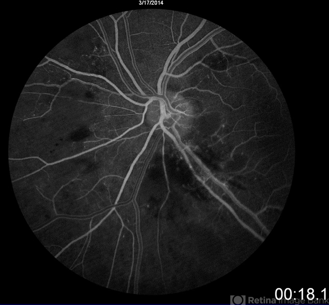 Radiation Retinopathy - Retina Image Bank