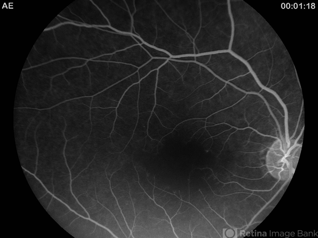 Bilateral Macular Infarction - Retina Image Bank