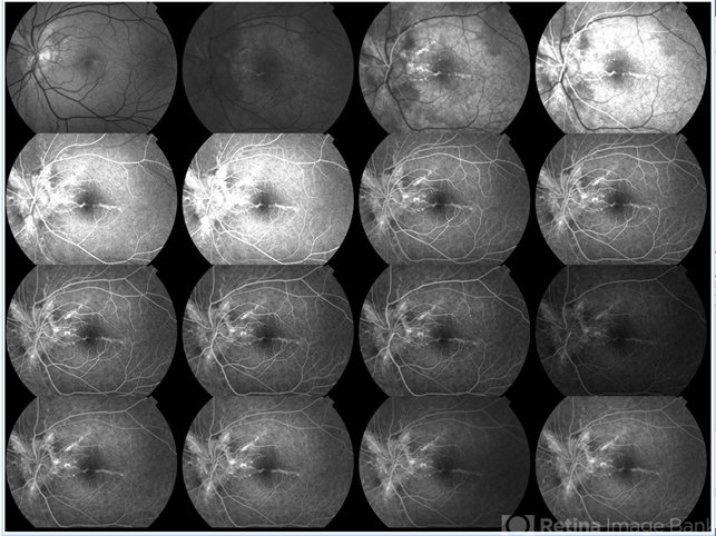 Fluorescein Angiography 1 In Patient With Pxe Retina Image Bank