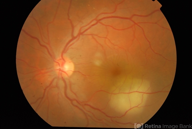 Tuberculoma - Retina Image Bank