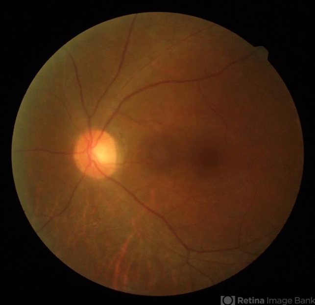 Pericentral HCQ (hydroxychloroquine) Toxicity - Retina Image Bank