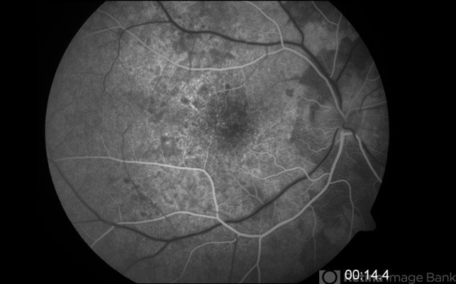 Acute Syphilitic Posterior Placoid Chorioretinitis - Retina Image Bank