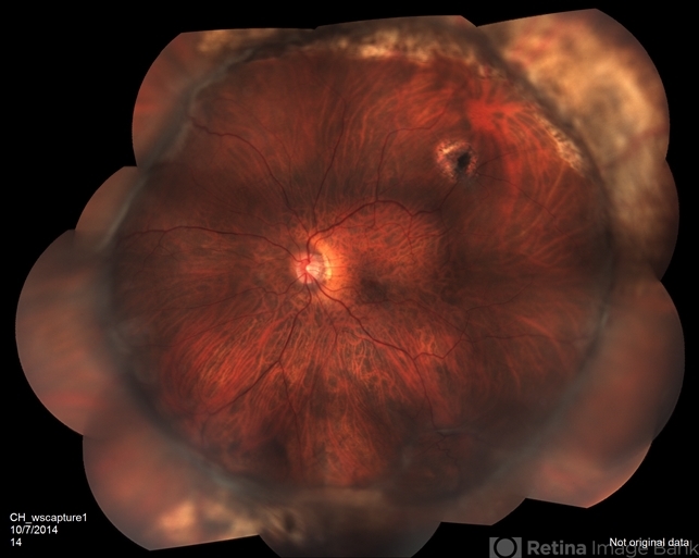 Proliferative Vitreoretinopathy - Retina Image Bank