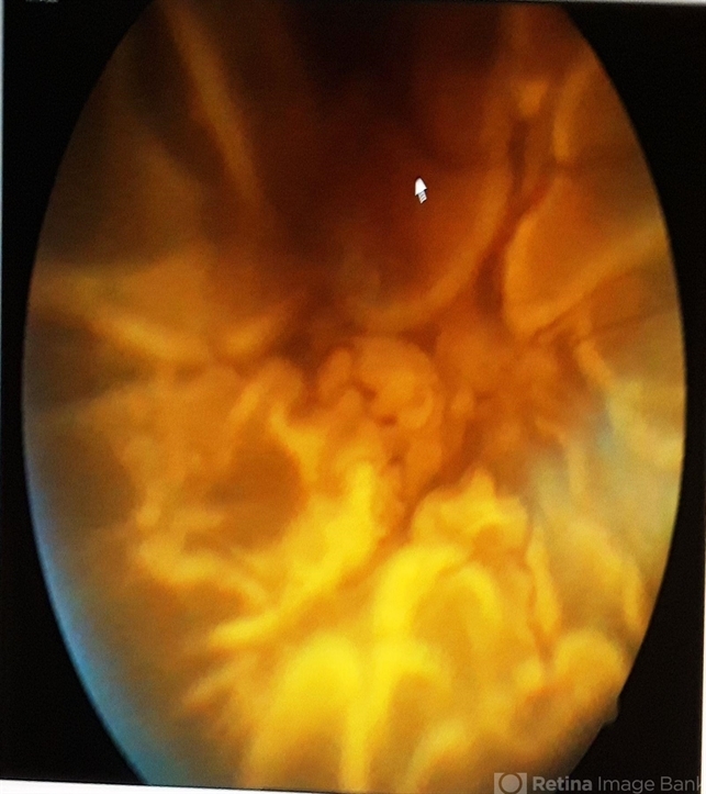 Closed Funnel Retinal Detachment Retina Image Bank