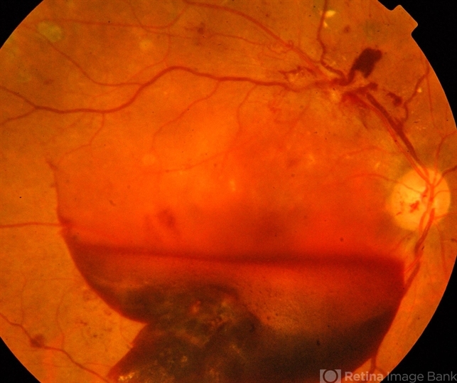 Donut-Shaped Subhyaloidal Hemorrhage - Retina Today