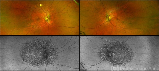 Elmiron Toxicity - Retina Image Bank