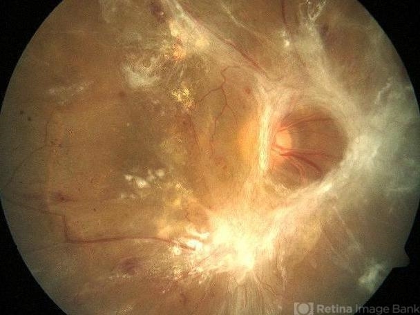 proliferative-diabetic-retinopathy-with-tractional-retinal-detachment