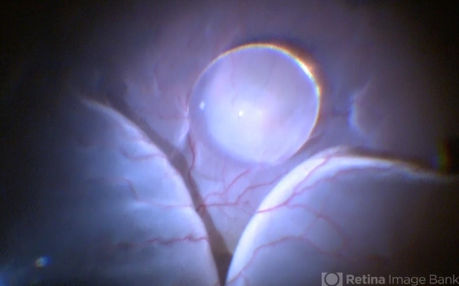 Bullous RD With Dislocated Lens - Retina Image Bank