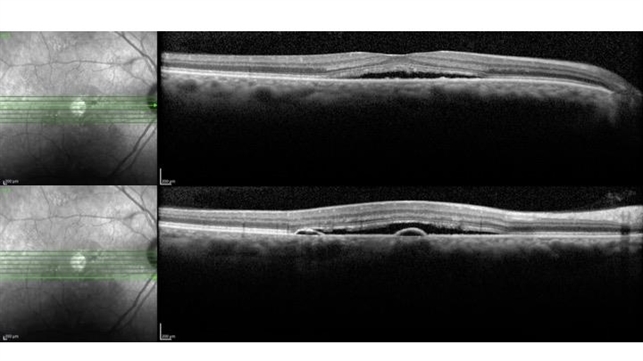 Csr On Raster Oct Central Serous Retinopathy Oct