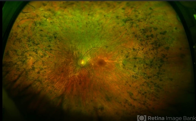 Retinitis Pigmentosa With Cystoid Macular Edema - Retina Image Bank