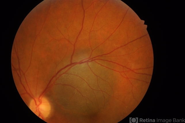 Choroidal Melanoma Kissing the Disc and Macula - Retina Image Bank