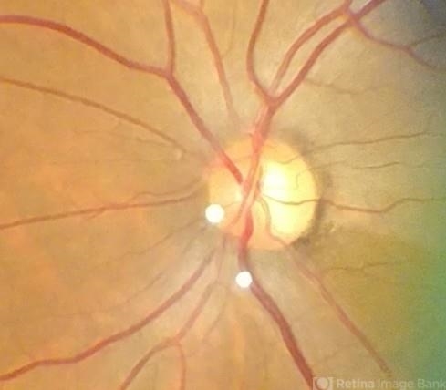 Optic Disc Notching - Zoomed and Cropped Image - Retina Image Bank