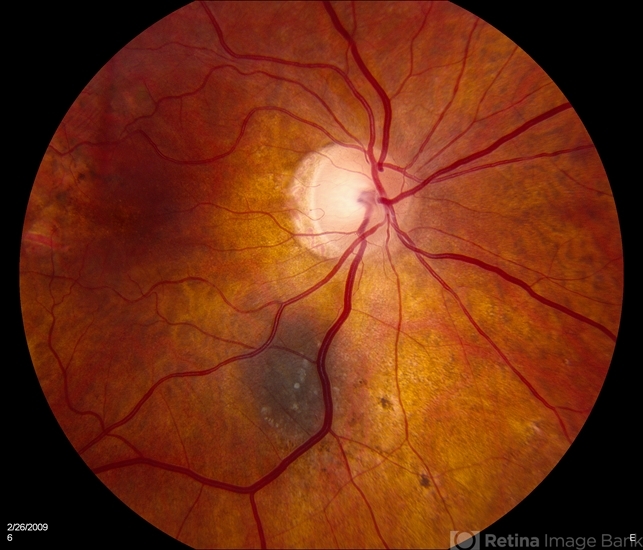 Benign Choroidal Nevus Retina Image Bank