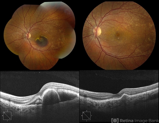 Submacular Hemorrhage Due to Malattia Leventinese - Retina Image Bank