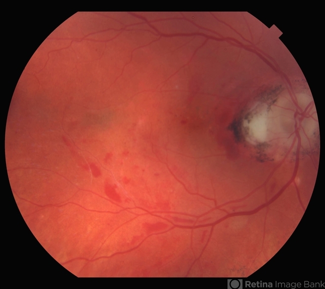 10 Days Post Subretinal TPA - Retina Image Bank