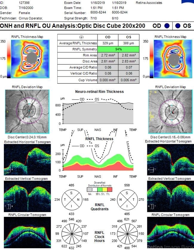 OCT in Patient With IIH Showing Thickened RNFL - Retina Image Bank