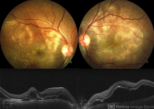 Vogt-Koyanagi-Harada Disease - Retina Image Bank