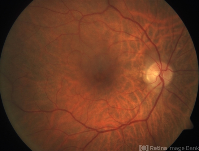 Severe Vitreomacular Traction - Retina Image Bank