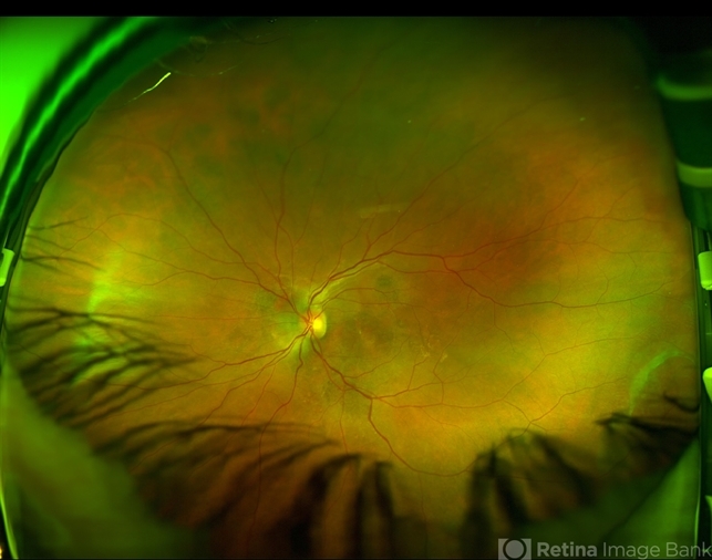 Chronic Central Serous Chorioretinopathy - Retina Image Bank