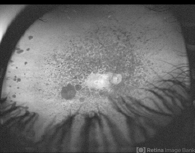 Retinitis Pigmentosa NA RE AF - Retina Image Bank