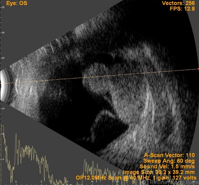 B-Scan Showing Intraocular Mass - Retina Image Bank