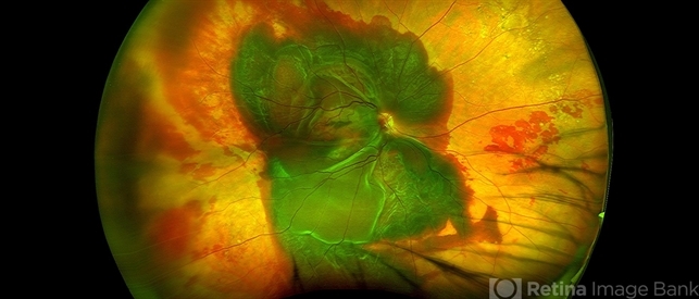 RPE Tear After Anti-VEGF Injection - Retina Image Bank