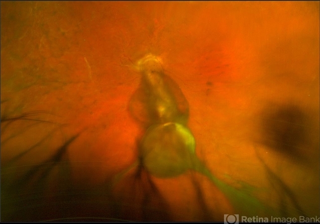 Closed Funnel Retinal Detachment Retina Image Bank