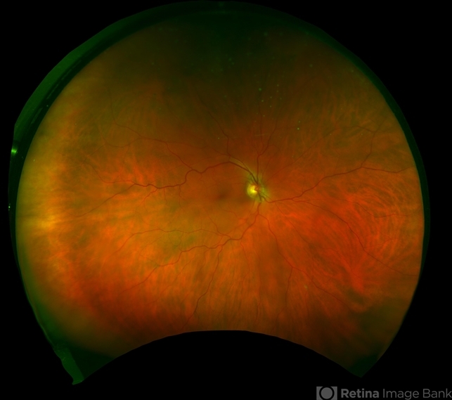 Vitreous Amyloidosis Postop - Retina Image Bank