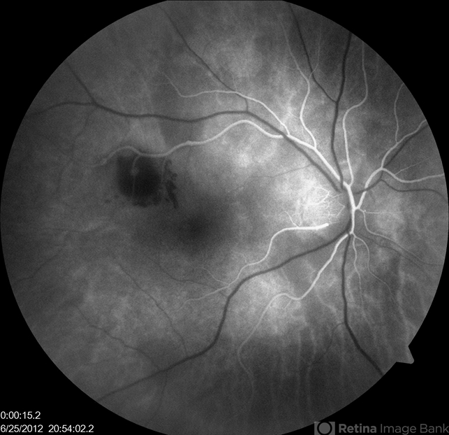 Ruptured Macroaneurysm - Retina Image Bank