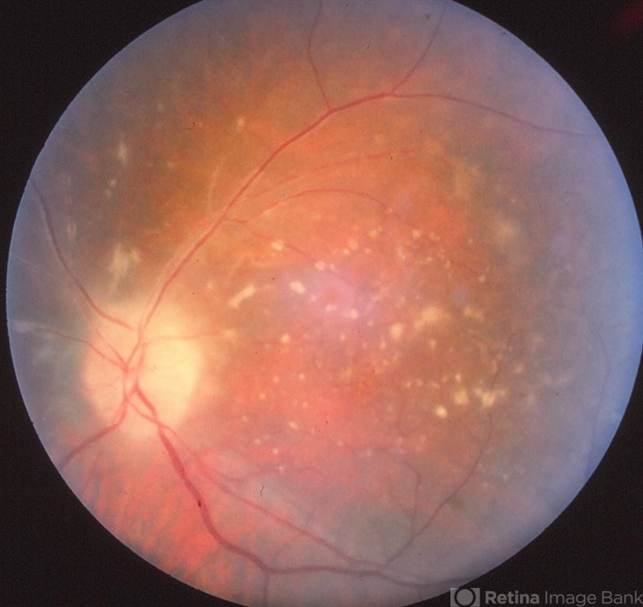 presentation of primary intraocular lymphoma