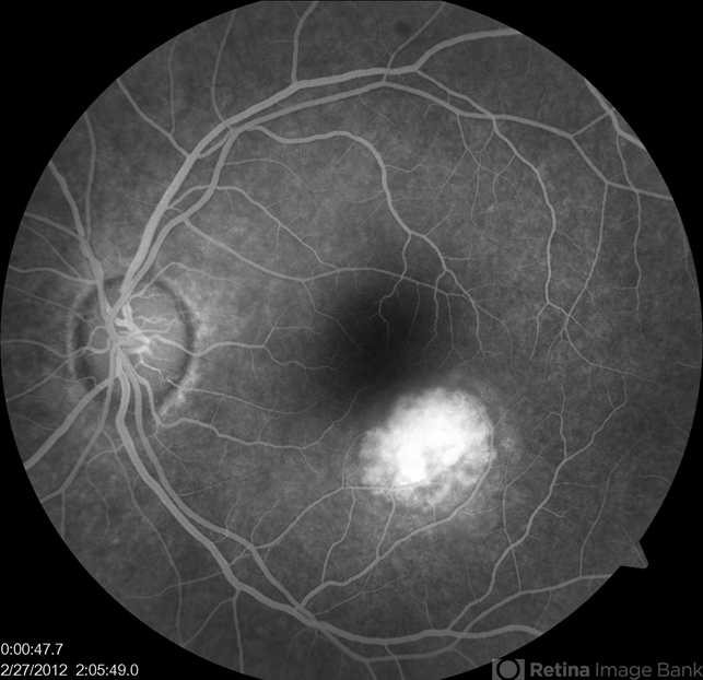 Presumed Ocular Histoplasmosis Syndrome With Cnv Retina Image Bank