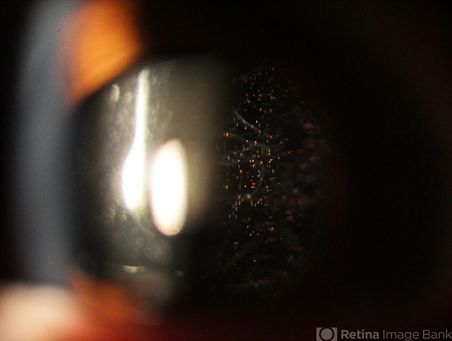 Schaffer's Sign - Retina Image Bank