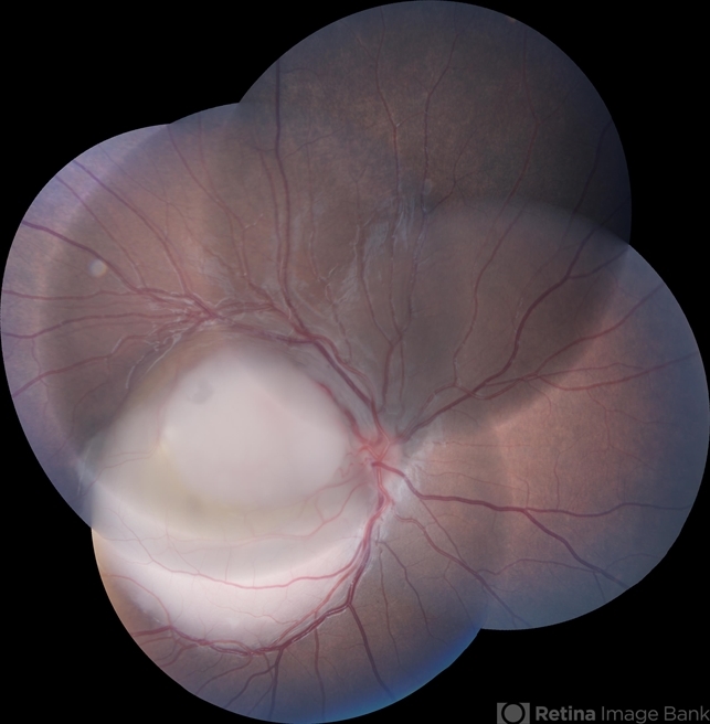 Retinoblastoma Group C Retina Image Bank 