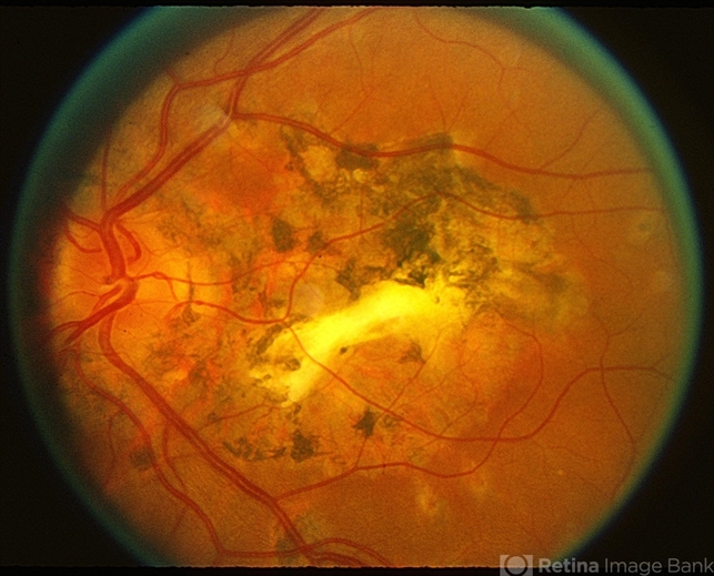 Old Presumed Ocular Histoplasmosis Syndrome Retina Image Bank