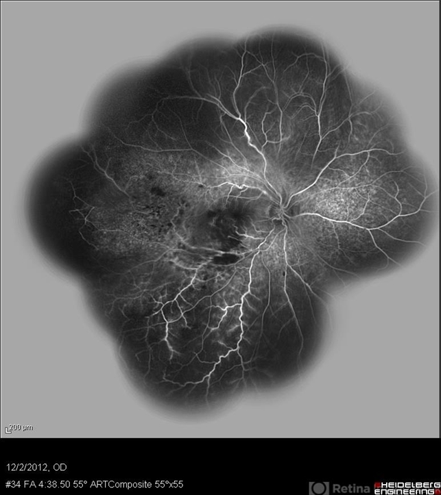 Behcet's Disease - Retina Image Bank