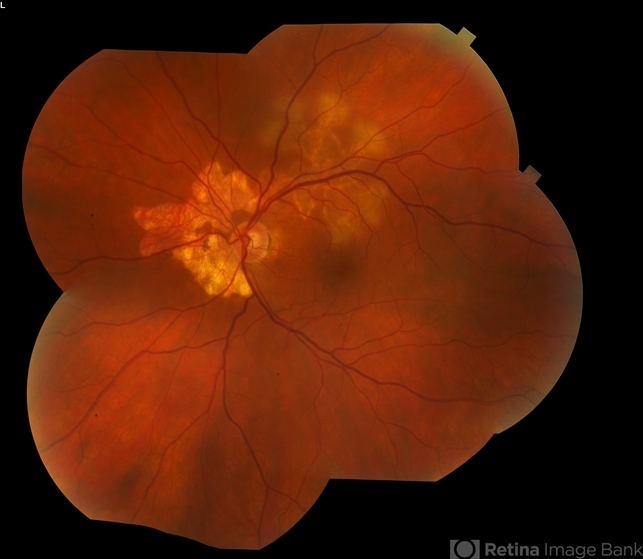 Serpiginous - Retina Image Bank