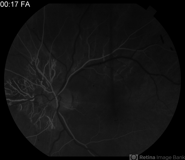 Serpiginous - Retina Image Bank