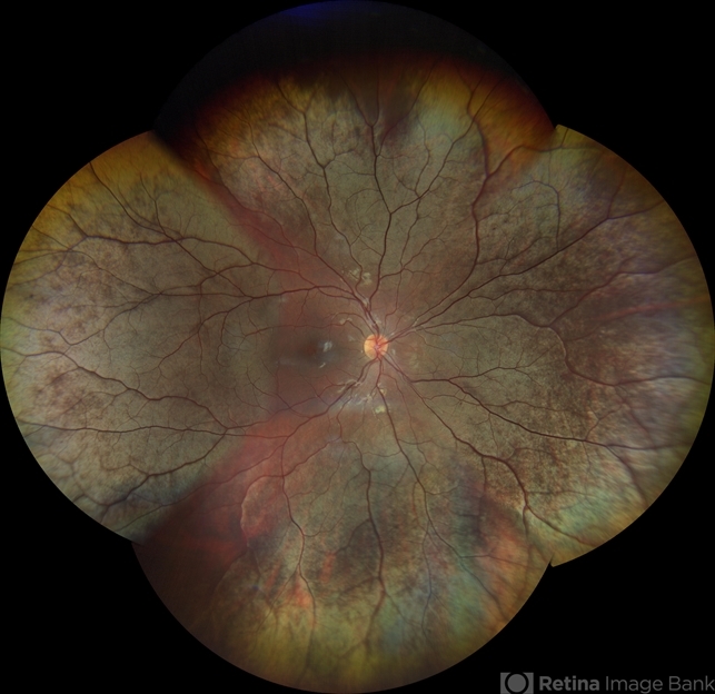 X-Linked Retinoschisis - Mizuo Nakamura Phenomenon - Retina Image Bank