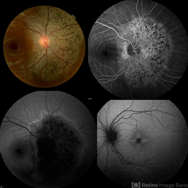 Unilateral Azoor - Retina Image Bank