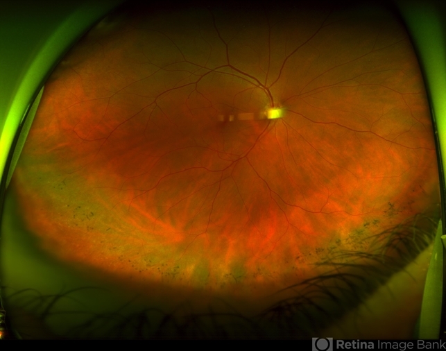 Pigmentary Retinal Dystrophy - Retina Image Bank