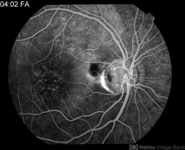 Optic Nerve Pit - Retina Image Bank