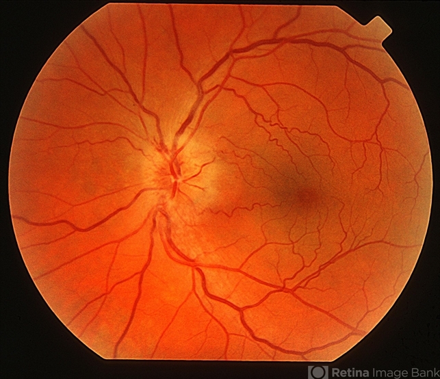 Ischemic Optic Neuropathies