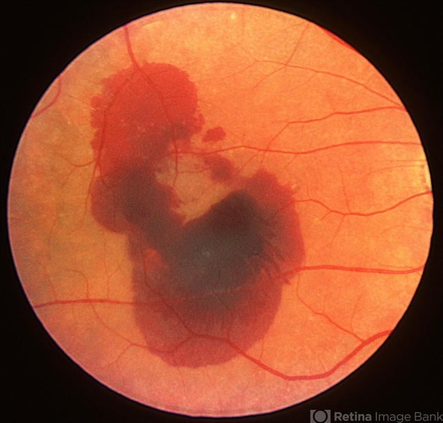 What Is Exudative Age Related Macular Degeneration