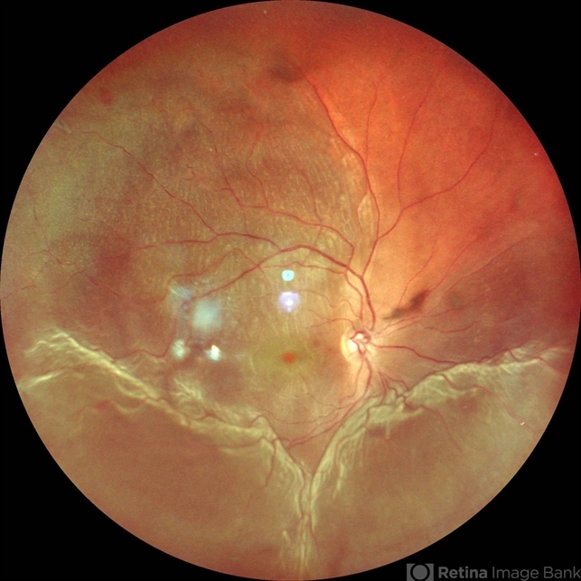 retinal-detachment-retina-image-bank