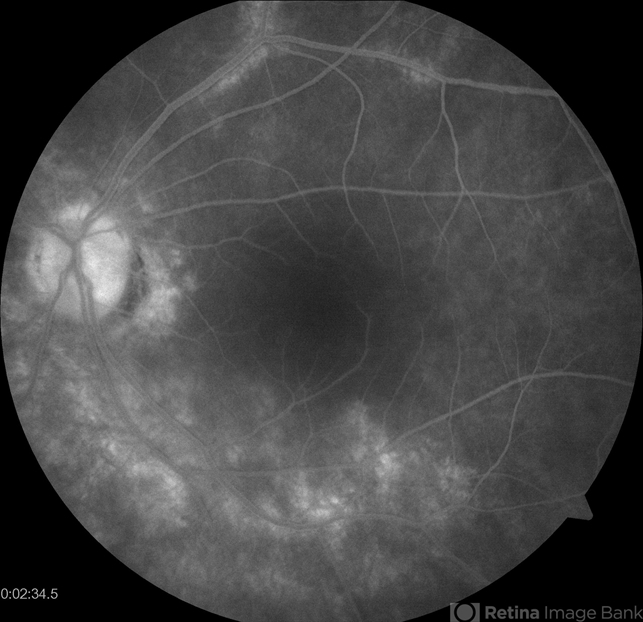 Birdshot Case #1 OS IVFA - Retina Image Bank