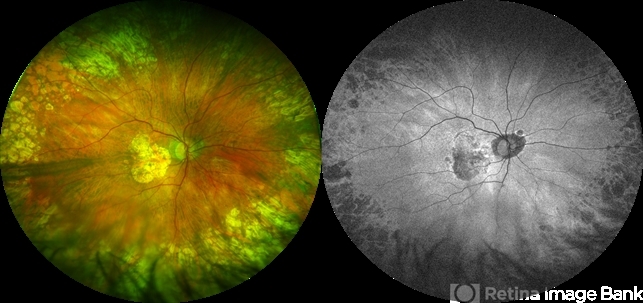 Extensive Macular Atrophy with Pseudodrusen-Like Appearance - Retina ...