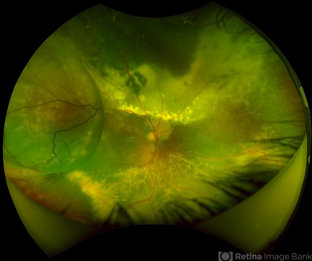 Ultra-Widefield Fundus Image of Coats' Disease with Exudative Retinal ...