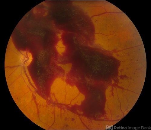 Macular Pre-Retinal Hemorrhage - Retina Image Bank