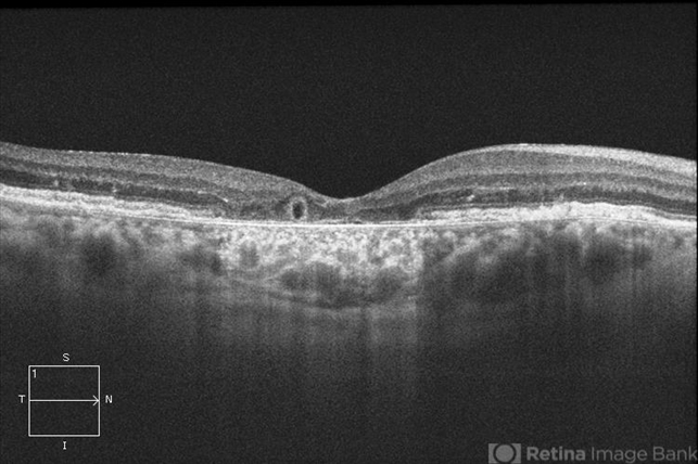 Outer-Retinal-Tubulation - Retina Image Bank