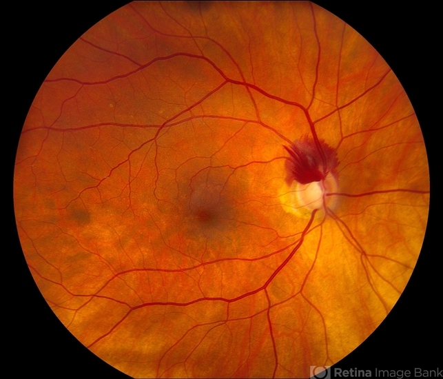 Superior Peripapillary Hemorrhage - Retina Image Bank